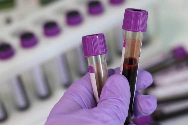 A hepatitis C-fertőzés évekig tünetmentes lehet
